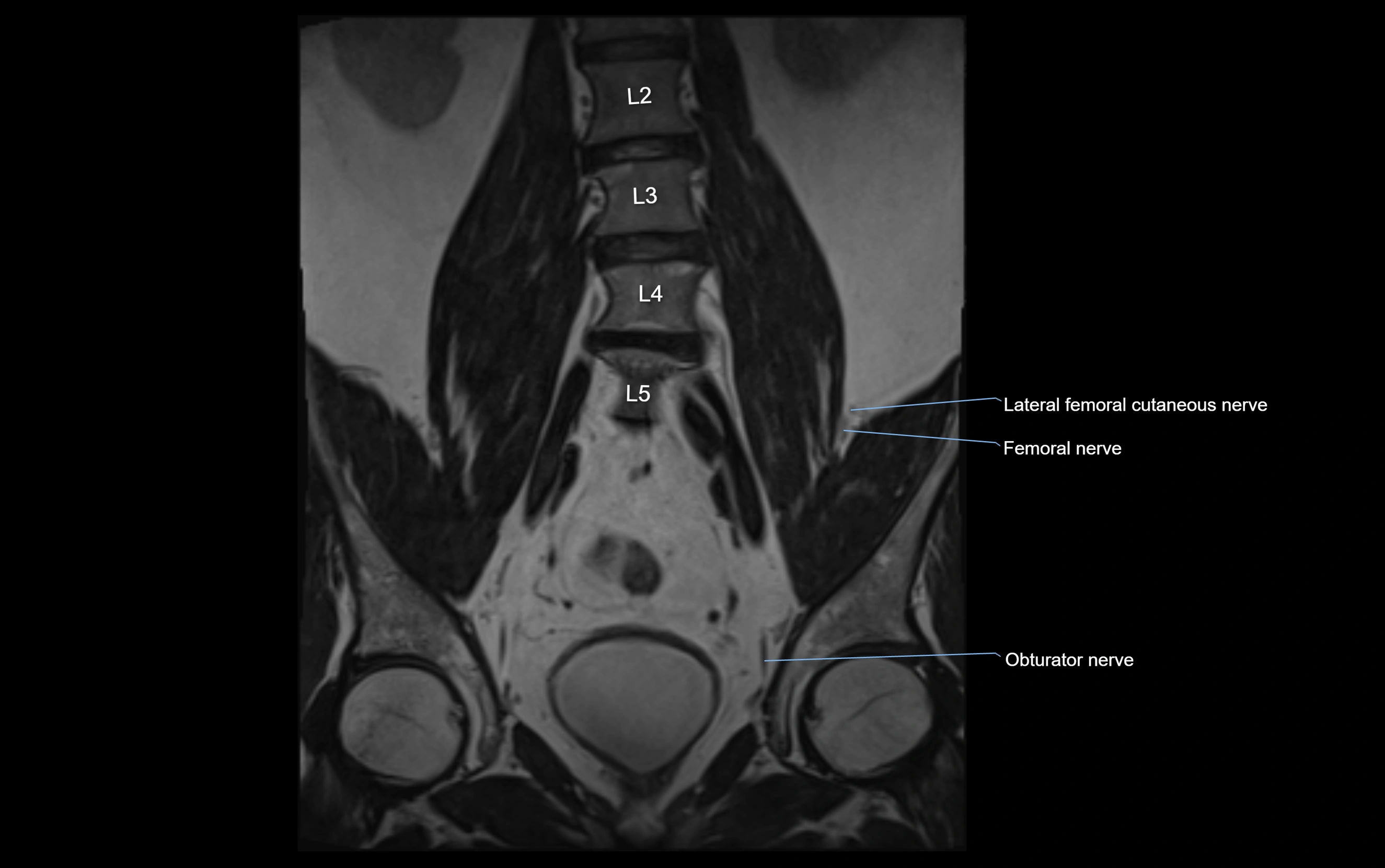 MR lumbosacral plexus cross sectional anatomy 3T  radiology  image-img-09001-00017.webp